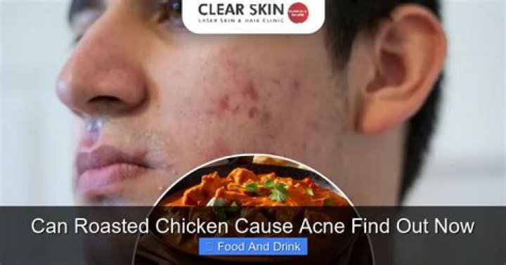 Can eating chicken cause acne?