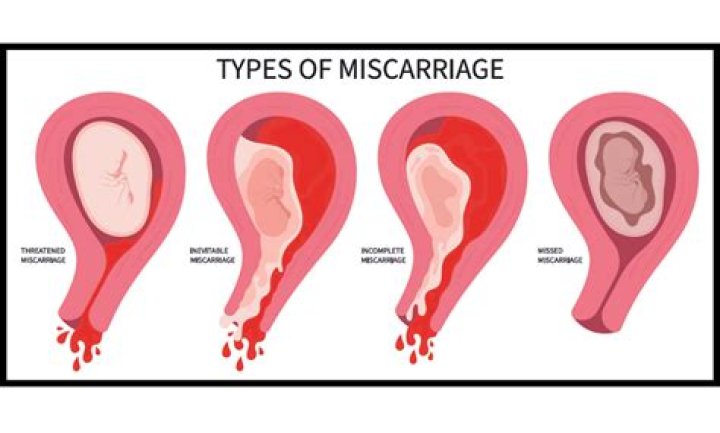 Does a miscarriage make you pee a lot?