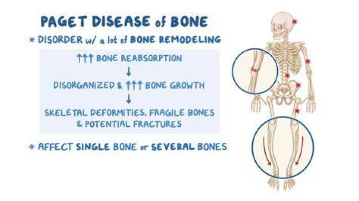 Does Paget's disease show in blood work?