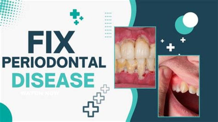 How do you fix severe periodontal disease?