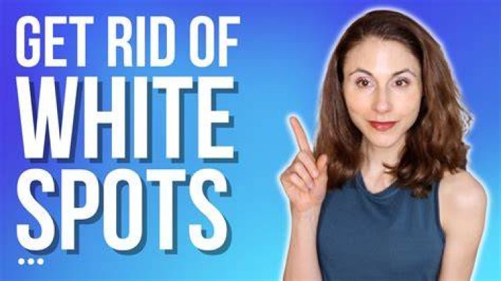How do you get rid of white spots on your feet?