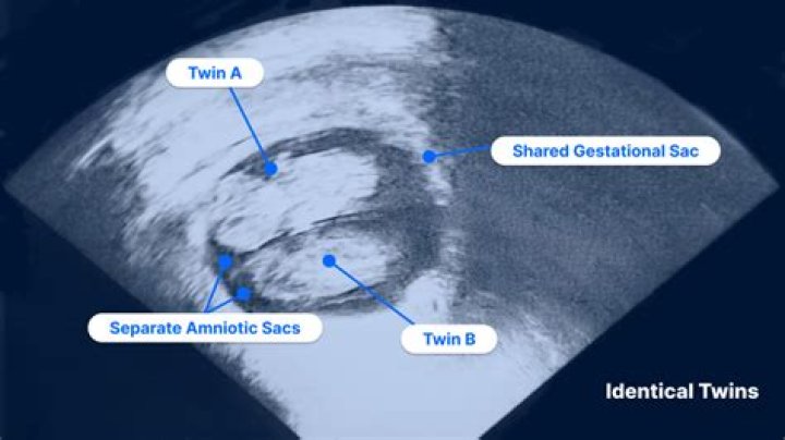 How does a twin feel when their twin dies at birth?