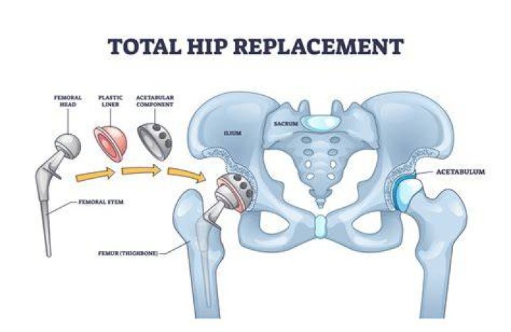 How many times can you get a hip replacement?