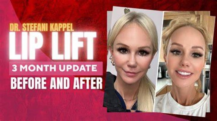 Is a lip lift worth it?
