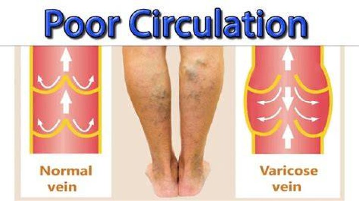 Is there medication for poor circulation?