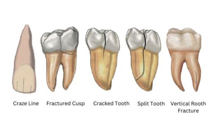 What can a cracked tooth lead to?