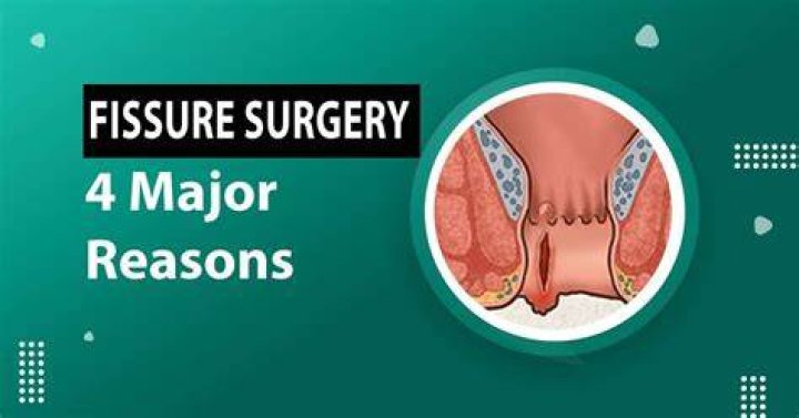 What is Fissurectomy?