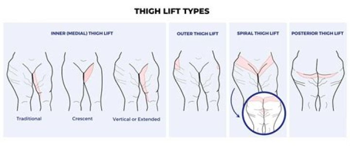 What is scarless thigh lift?