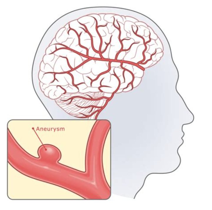 What were your first signs of a brain aneurysm?