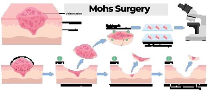 Why is it called Mohs surgery?